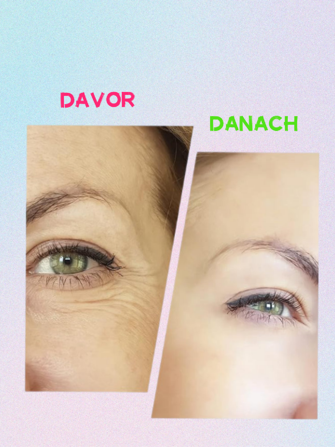 Madame-Glatt Glowlift